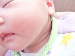 乳児湿疹が顔だけにできた！？