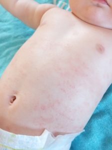 乳児湿疹はいつからいつまで？