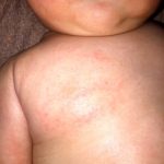 乳児湿疹が体の全身にできた時のケア方法