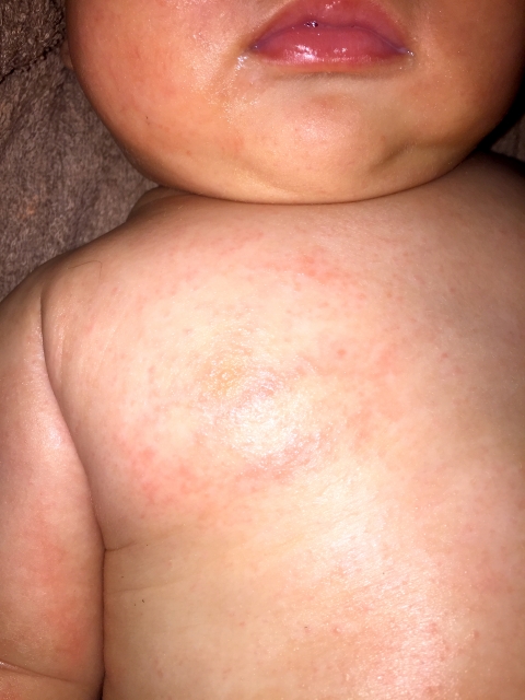 乳児湿疹が体の全身にできた時のケア方法