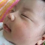 新生児の顔にできた湿疹