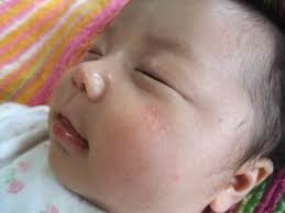 新生児の顔にできた湿疹