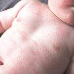 乳児湿疹に保湿剤がおすすめ！